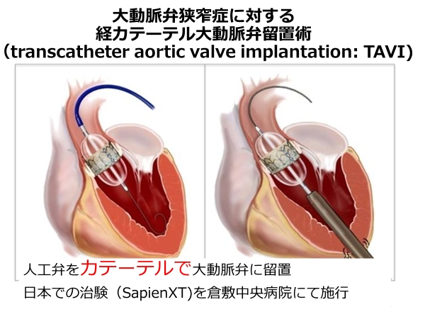 TAVI（経カテーテル的大動脈弁留置術）1