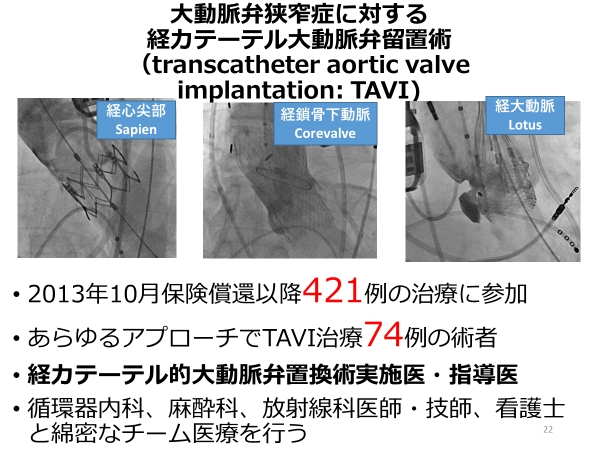 TAVI（経カテーテル的大動脈弁留置術）2