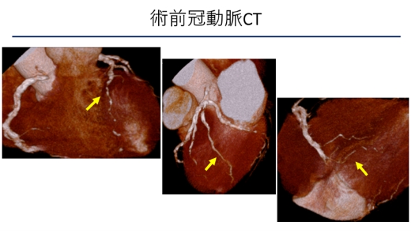 浜松労災病院でのMICS-CABG症例1