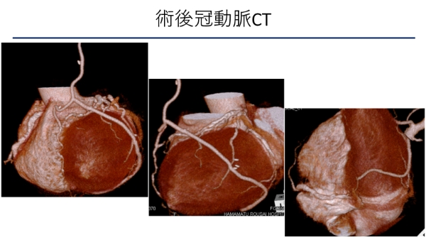 浜松労災病院でのMICS-CABG症例3