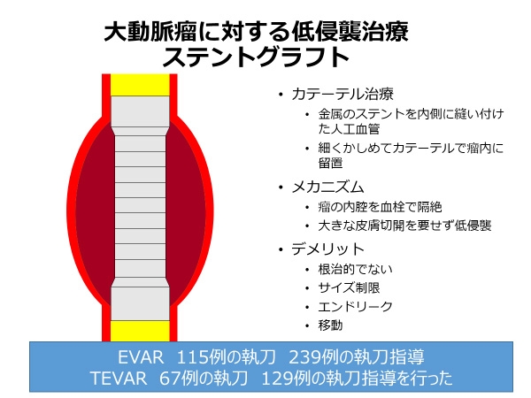 ステントグラフト治療