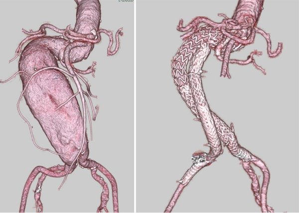 腹部大動脈ステントグラフトの症例1