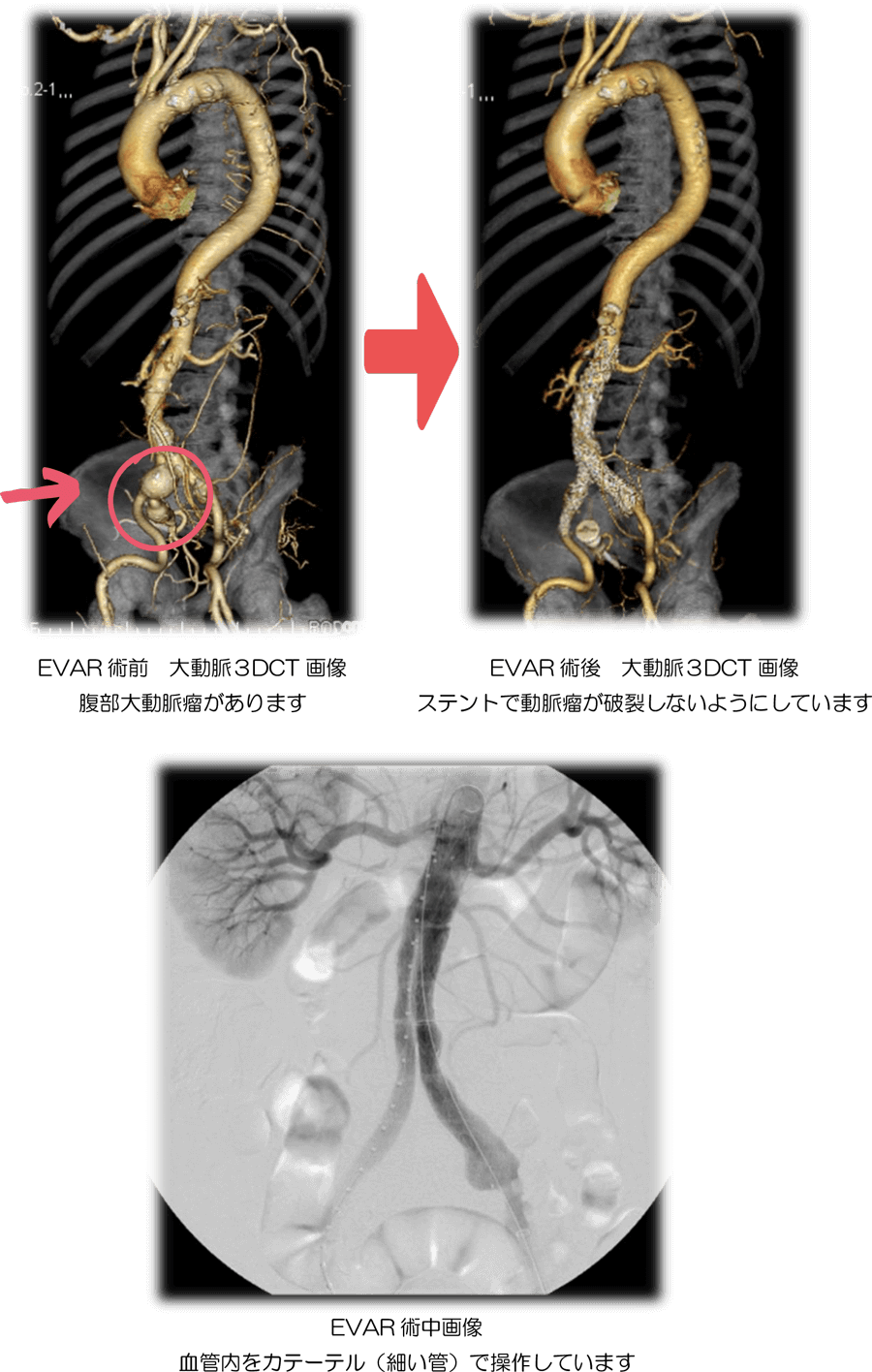 大動脈ステントグラフト（EVAR/TEVAR）2