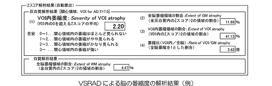 VSRAD（ブイエスラド）