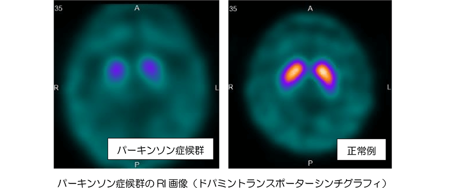 パーキンソン症候群やレビー小体型認知症の診断