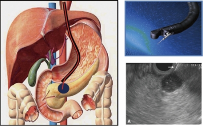 超音波内視鏡下穿刺吸引法